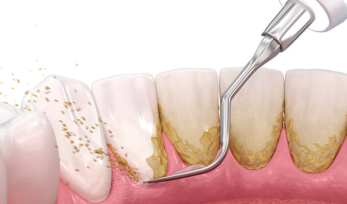 SRP（歯ぐきの下に隠れている歯石の除去）
