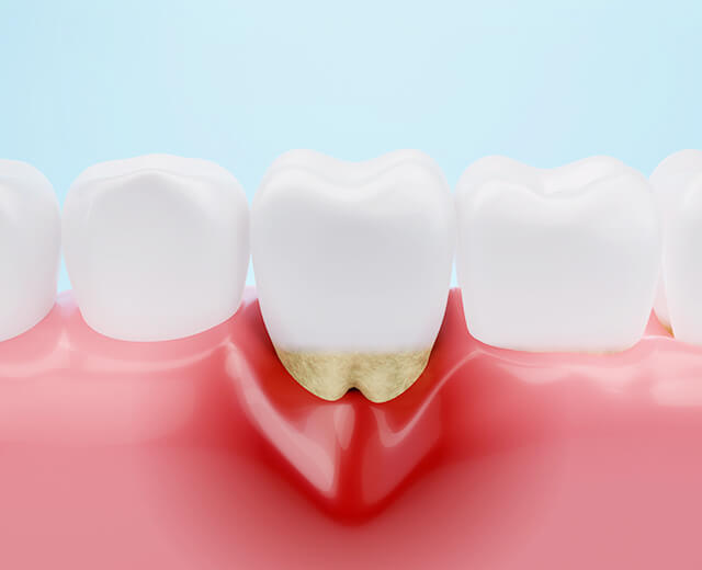 歯周病改善の取り組み