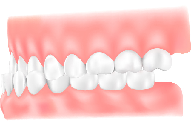 受け口（反対咬合・下顎前突）
