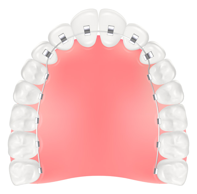 リンガルブラケット(舌側矯正)